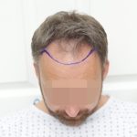 Hair Line Placement in Hair Transplant Surgery: A Complete Guide for Natural Results