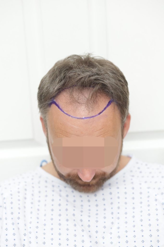 Hair Line Placement in Hair Transplant Surgery: A Complete Guide for Natural Results