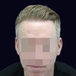 UK Hair Transplant Costs: Complete UK Pricing Guide 2026- 2027