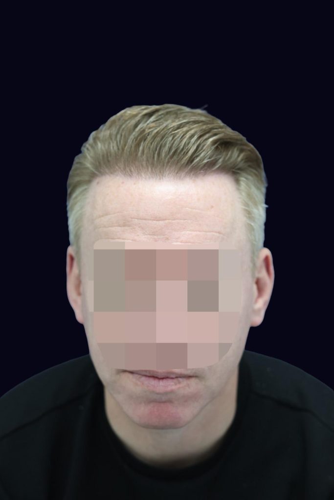 UK Hair Transplant Costs: Complete UK Pricing Guide 2026- 2027