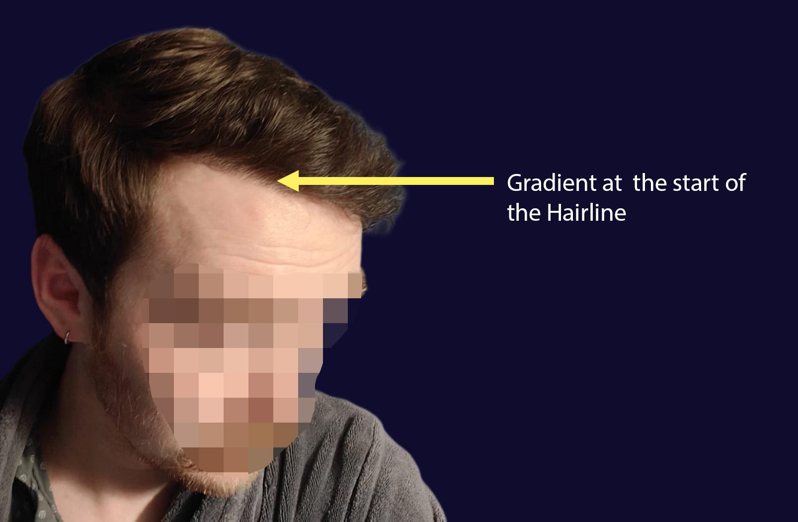 Dr Kunnure Clinic - An overhead view of a scalp illustrates varying hair density, showing sparse hair at the front transitioning to thicker hair towards the back, highlighting natural hair growth patterns. This image could be relevant for discussions about hair restoration and the impact of hair loss on the natural hairline.