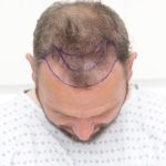 Hair Loss and Mental Health: Understanding the Connection between mind and hair and Finding Support