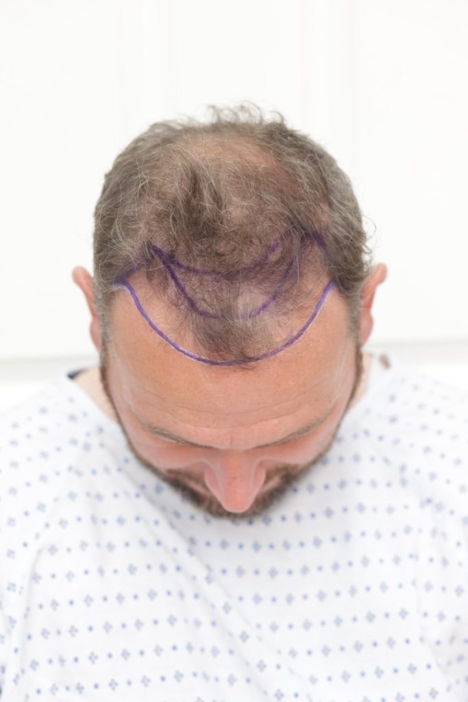 Hair Loss and Mental Health: Understanding the Connection between mind and hair and Finding Support